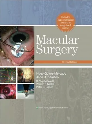 Macular Surgery handout